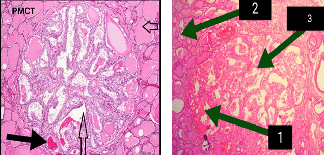 Psammoma Bodies could also be seen Arrow Shows Papillae Surrounded by Normal Thyroid Tissue