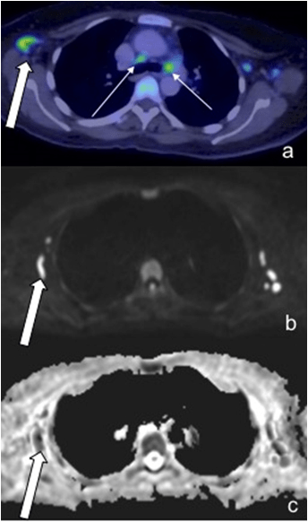 A 65-Year-Old Female with DLBCL. PET/CT Demonstrated Increased Uptake