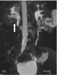 Uro-MRI (MIP) Showed an Amputation of the Inferior Calices in Right Renal with a Filling Defect in the Right Renal Pelvis