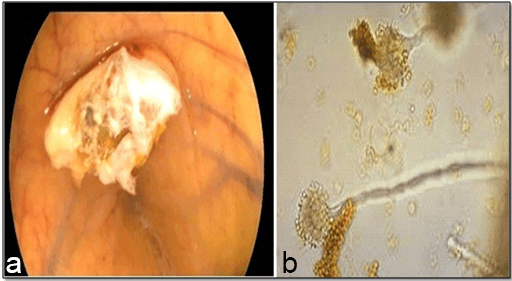 Showing the Endoscopic View of Fungal Growth