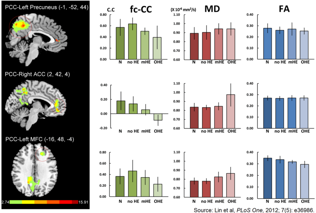 Connectivity of Default-Mode Network Is Associated with Cerebral Edema in Hepatic Encephalopathy
