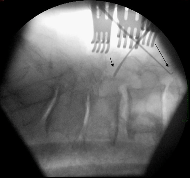Intra-operative (Step 3) X-ray Shows Hooks