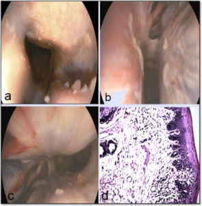 Showing the Mucopurulent Exudates in the Nasal Cavity