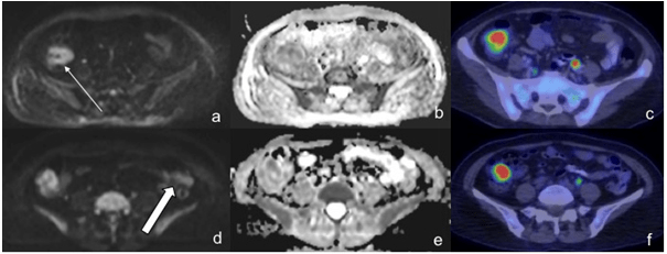 A 65-Year-Old Female Patient with DLBCL, in the Pre-Treatment DWI