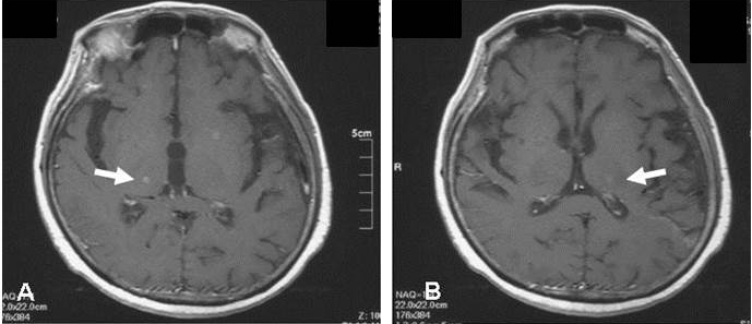 Bilateral Symmetric Thalamic Metastasis in a Patient with Small Cell Lung Cancer