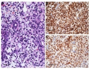 Figure 3: Liver with metastatic melanoma. (A) Hepatic parenchyma replaced by melanoma - small, non pigmented, epithelioid cells with scant cytoplasm and hyperchromatic nuclei. (Hematoxylin-eosin, original magnification x200) (B) HMB45 immunohistochemical stain shows diffuse cytoplasmic staining in the tumor cells. (Original magnification x200) (C) Melan A/MART-1 immunohistochemical stain shows diffuse cytoplasmic staining in the tumor cells. (Original magnification x200).