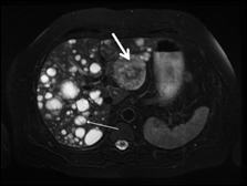 Figure 1: Abdominal MRI showing numerous hepatic cysts and cystic masses. A 6 cm mass in segment 2 (thick white arrow) is remarkable for mild peripheral enhancement and intralesional hemorrhage. A 2 cm complex appearing cystic mass is noted at the junction of segments 6 and 7 (thin white arrow).