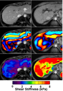 Figure1: Normal liver is pictured on the left and the cirrhotic liver on the right. The top image is the MRI scan, the second row show the shear wave signal and the third, the integrated shear stiffness in kPa, colour coded as shown.