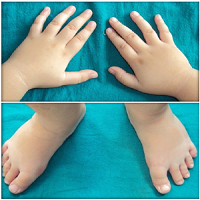 Prader-Willi Syndrome: A Case Report