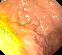 Massive Gastric Variceal Bleeding in a Patient with Chronic Pancreatitis