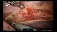 Robot-Assisted Minimally Invasive McKeown Esophagectomy with a Four-Arm Platform: Technique and Early Experience
