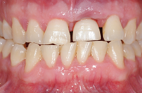 Peri-Implantitis: A Review of the Disease and Report of a Case