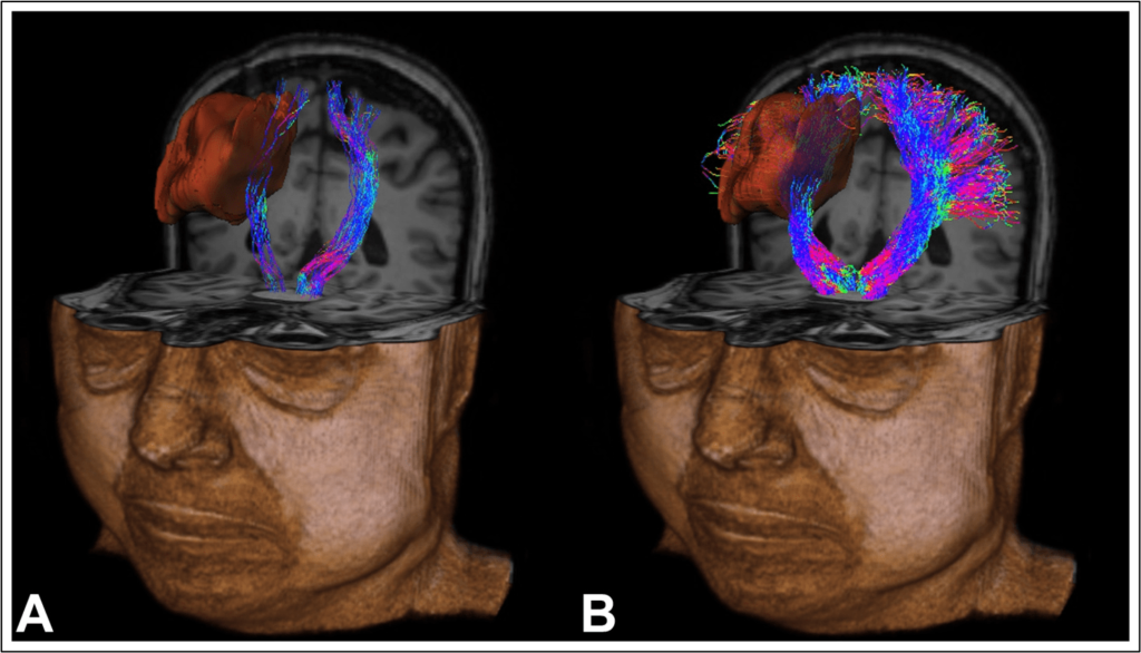 Comparative qualitative analysis of bilateral CST reconstructions in a patient with right high-grade glioma