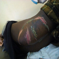 The Right Thigh Anterior Compartment was Swollen, and the Skin was Ulcerated due to the Traditional Cautery