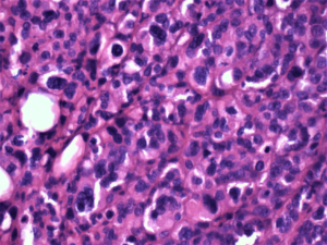 Pleomorphic Giant Cell Carcinoma Displaying Bizarre Multinucleated