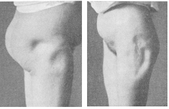 One of the First Cases of Lipoatrophy
