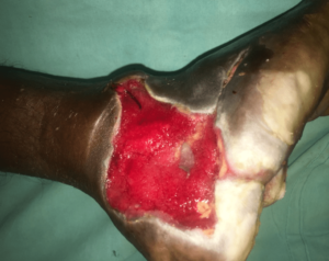 After Wound Bed Preparation