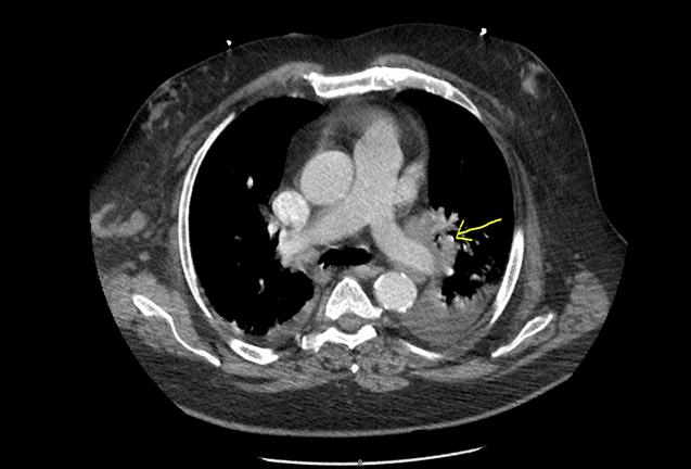An Unusual Presentation of New Onset Sarcoidosis