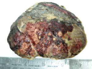 Neuroblastoma gross pathology