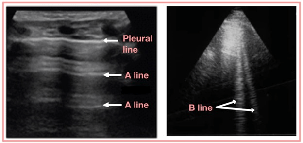 Left-side Image Showing Lung A-line and Right-side Image Shows the Lung B-line
