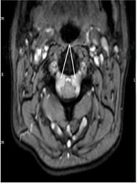 Cranial and Spinal Subdural Hygroma Following