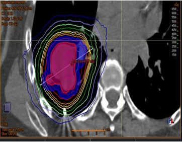 Dosimetric Characterization of an Abscopal Response in a Patient With Oligometastatic Melanoma Undergoing Concurrent Treatment With Pembrolizumab and Stereotactic Body Radiotherapy