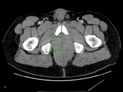 Endoscopic Ultrasound Diagnosis of Perianal Rhabdomyosarcoma