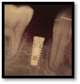 Management of Missing Second Premolar with Single-Tooth