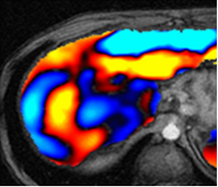 Magnetic Resonance Elastography Comes of Age