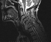 A Case of Cervical Spine Tuberculosis