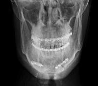 Bilateral Body of Mandible Fracture