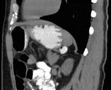 Gastric Diverticulum Misdiagnosed as a Left Adrenal Lesion