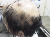 Successful Treatment of Multiple Alopecia Areata