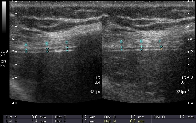 Diaphragm Ultrasonography as a Tool To Assess the Respiratory Issues of a Patient With Amyotrophic Lateral Sclerosis (ALS)