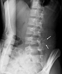 Myositis Ossificans in the Lumbar Spine: A Case Report