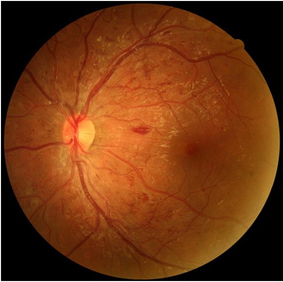 Figure 2: Forty-five degree field of view of the left retina captured in non-mydriatic mode in july 2015 (left eye).