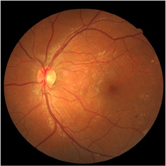 Figure 3: Forty-five degree field of view of the left retina captured in non-mydriatic mode in July 2016 (left eye).