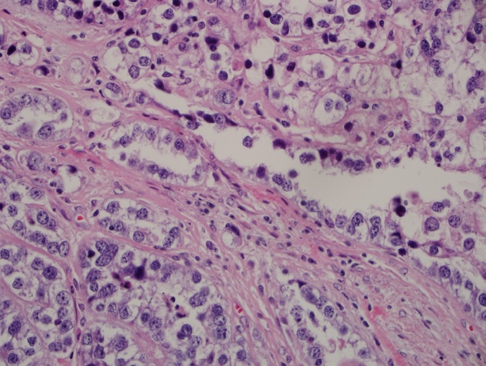 Mixed Epithelial and Germ Cell Ovarian Cancer: A Case Report
