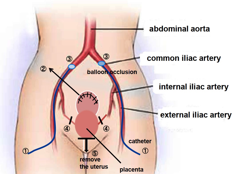 Cesarean Hysterectomy for Abnormal Placentation Using Balloon Occlusion of the Common Iliac Artery: Case Series
