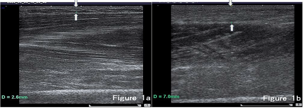 Measurement of Women’s Leg Edema Using Ultrasonography