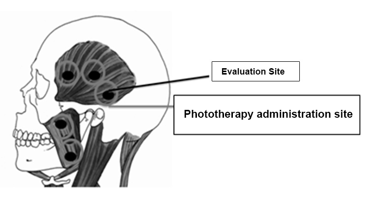 Influence of Phototherapy on Thermographic Images