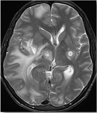 Cerebral Toxoplasmosis in a Treatment