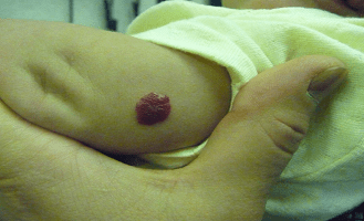 Infantile Hemangioma