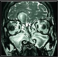Imaging of Paranasal Sinus Mucoceles