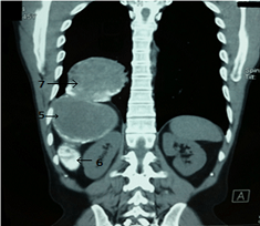 The Trans-Diaphragmatic Hydatid Cyst An Unconventional