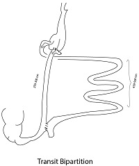 Ileal Interposition with Gastric Bipartition