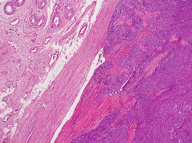 Testicular Adult Type Granulosa Cell Tumor