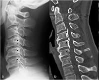 Evaluation of the Ossification of the Cervical