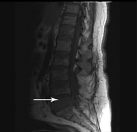 Traumatic Spinal Epidural Hematoma with Neurological Deficit