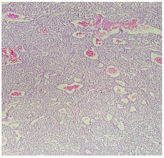 A Case Report of Carcinoid Tumor of the Kidney